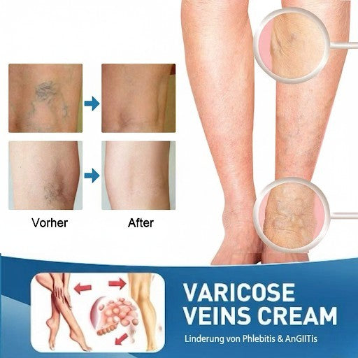 LBMLBM™ Effektive Krampfader-Creme – Linderung von Beinschmerzen & Verbesserung der Durchblutung