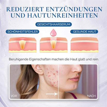 🌿Natürliche Behandlung zu Hause für Gesichtsbehaarung bei PCOS