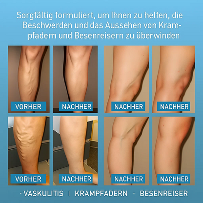 LBMLBM™ Effektive Krampfader-Creme – Linderung von Beinschmerzen & Verbesserung der Durchblutung