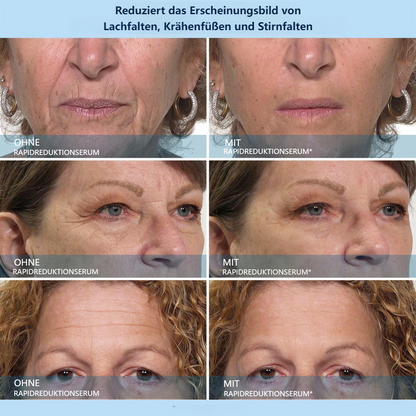 🟩LBMLBM™ Serum zur schnellen Faltenreduzierung